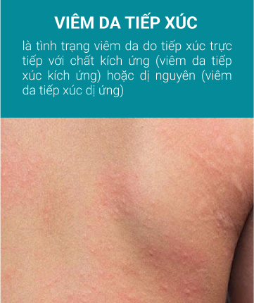 viem da tiep xuc fix